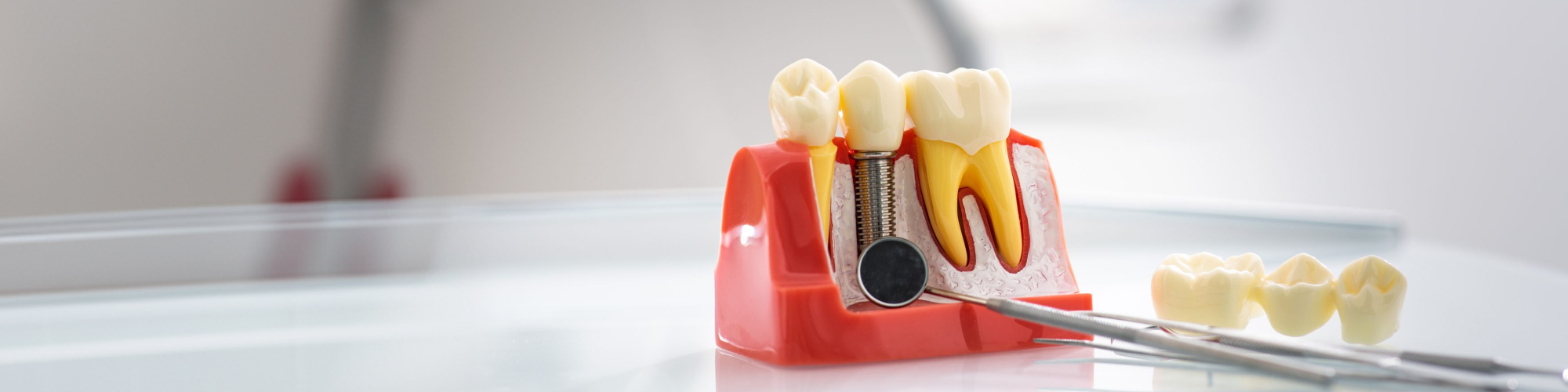 Dental implant between teeth in a jaw model.